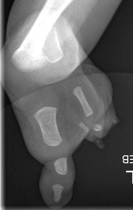 fibular hemimelia