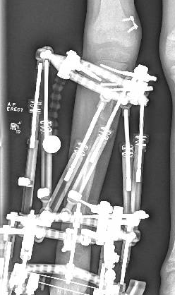 Fibular hemimelia