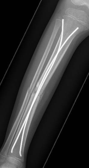 Tibial tens