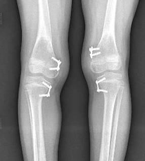 rickets