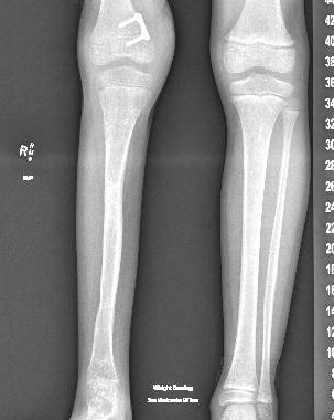 Fibular hemimelia