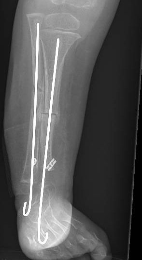 Tibial hemimelia