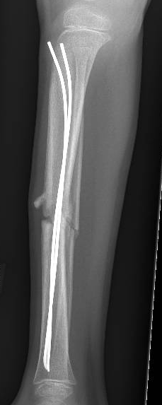 tibial tens