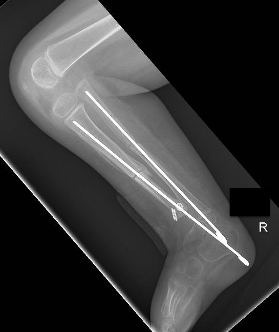 tibial hemimelia