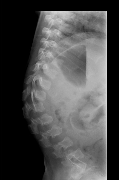 achondroplasia