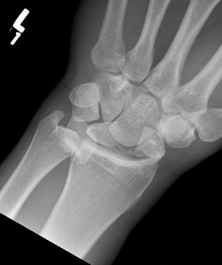 Lunate dislocation