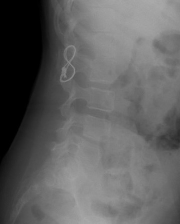 Ped spine #