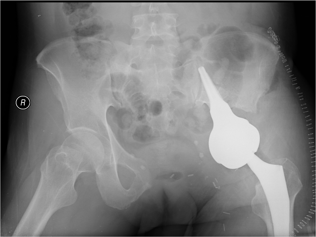 Pelvis wide resection