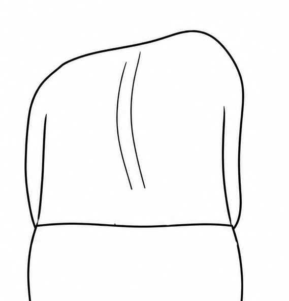 Rib hump