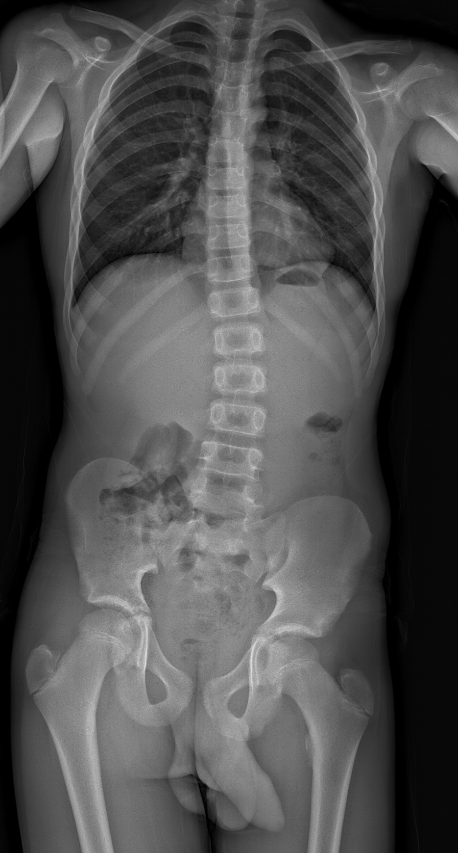 Scoliosis LLD