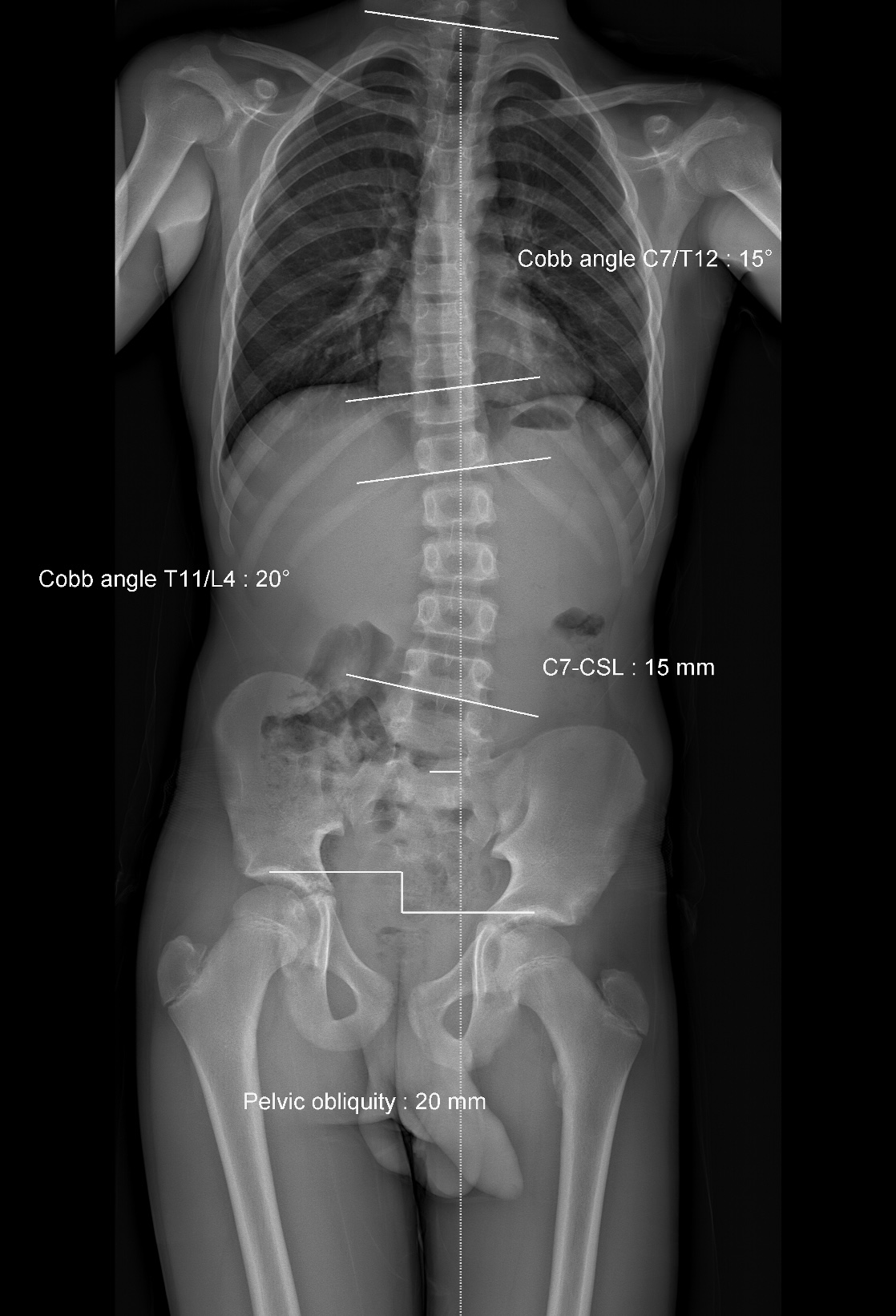 Scoliosis LLD