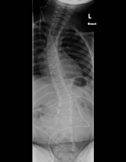 Spina bifida scoliosis