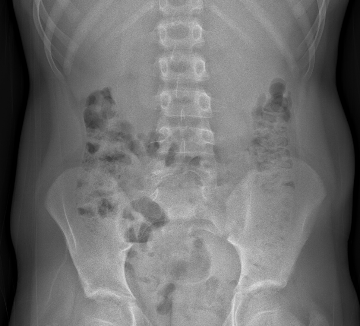 Spina bifida occulta