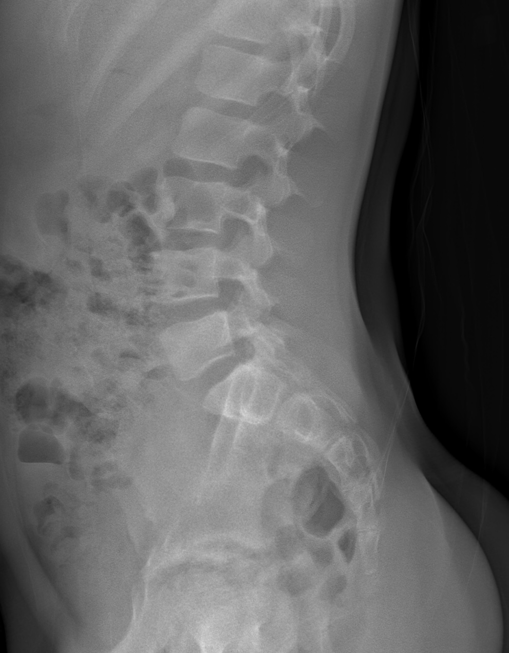 Spina bifida occulta